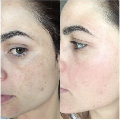 Ultra Whitening Serum Reduce Dark Spot